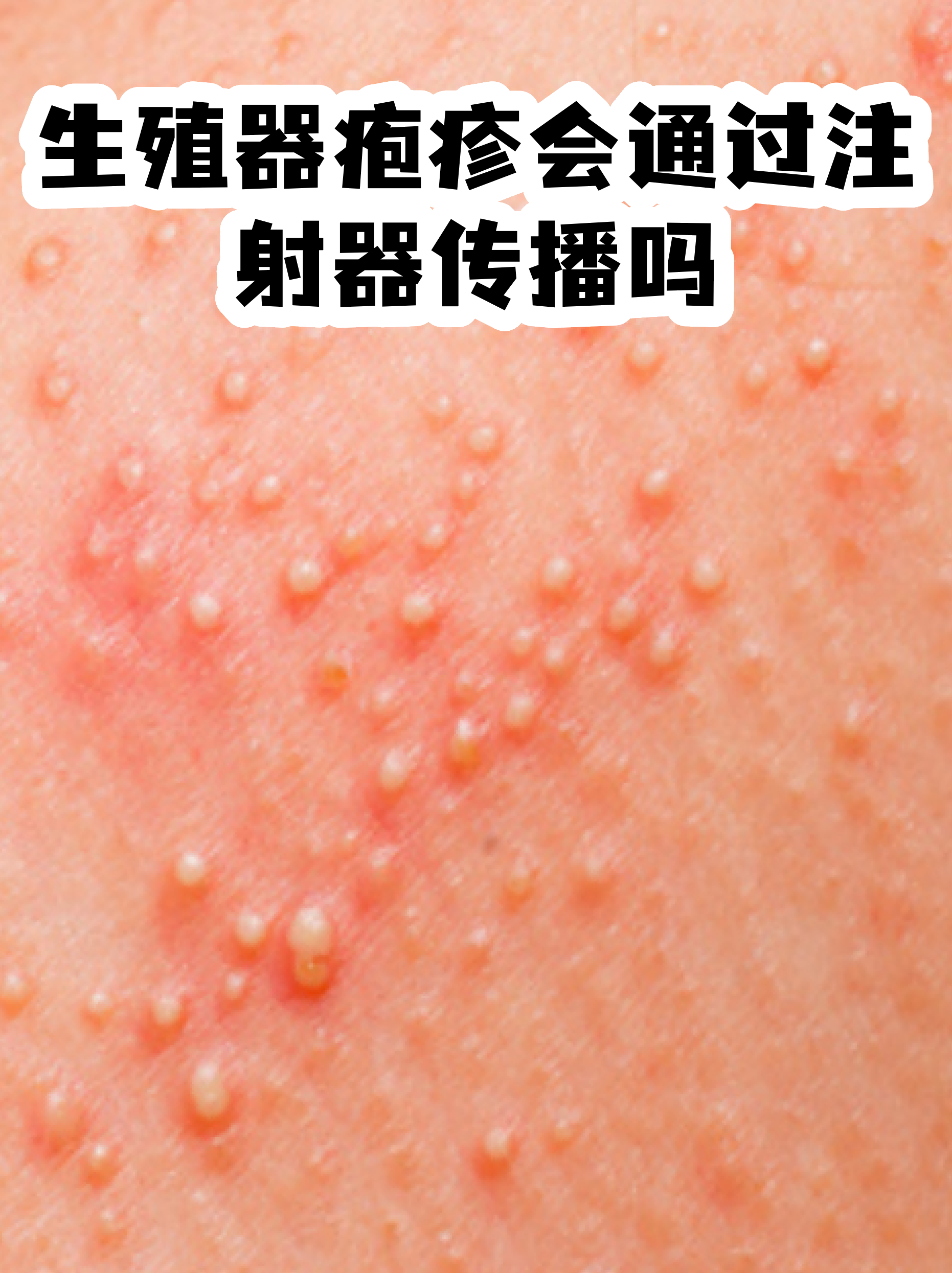  注射病毒会传染什么病(疫苗里的病毒会传染么)