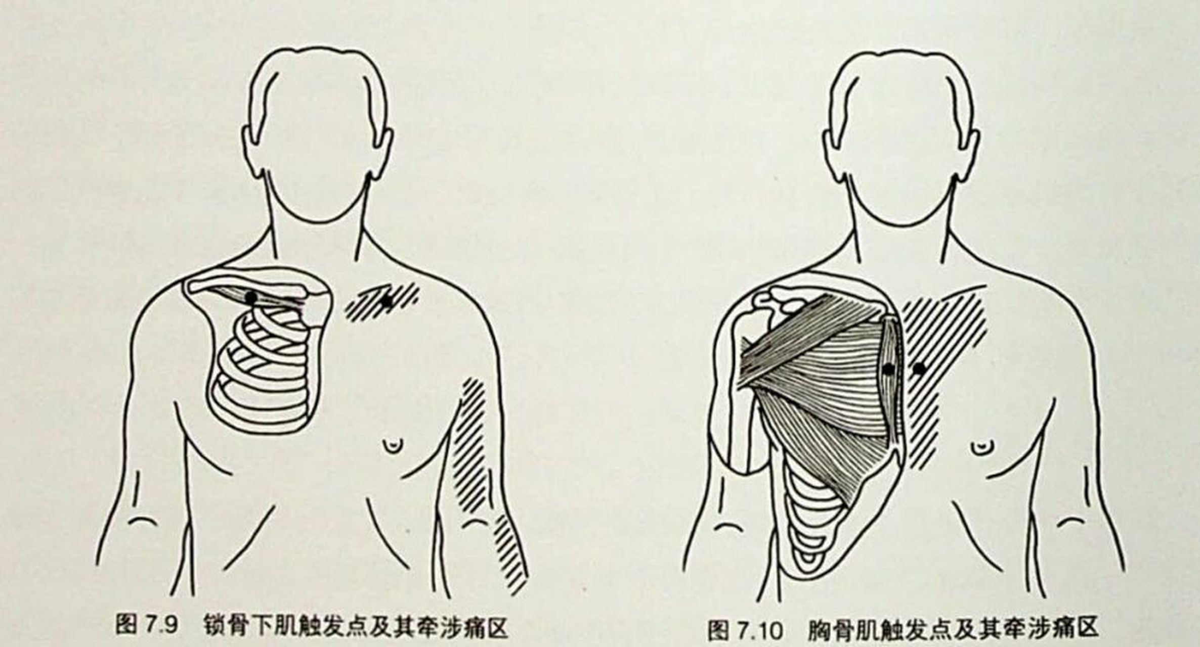 锁骨下肌和胸骨肌 锁骨下肌 锁骨下肌位于锁骨下方,一端连接锁骨中部