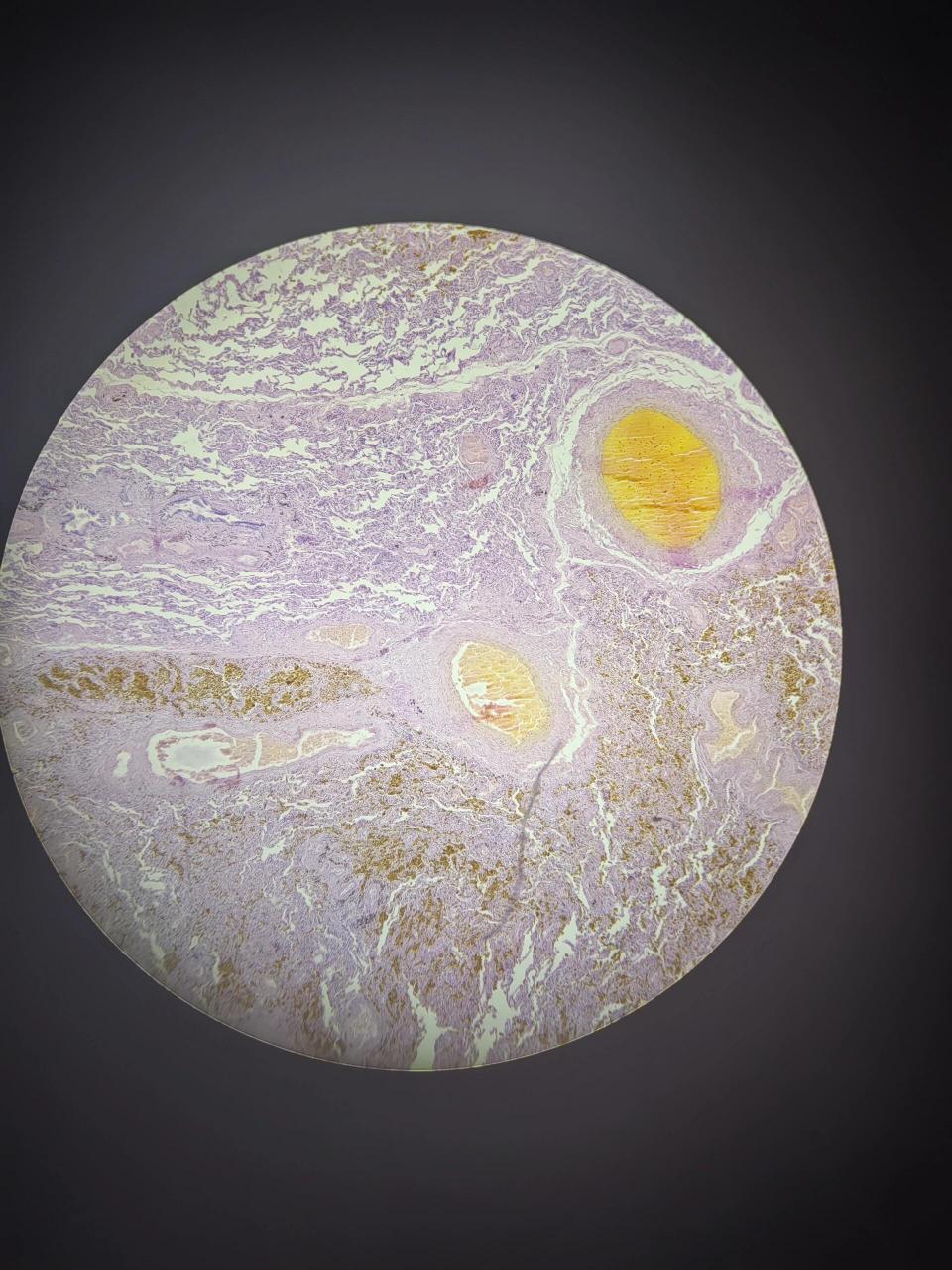 慢性肺淤血 慢性肺淤血 4*0.1 10*0.25 10*40