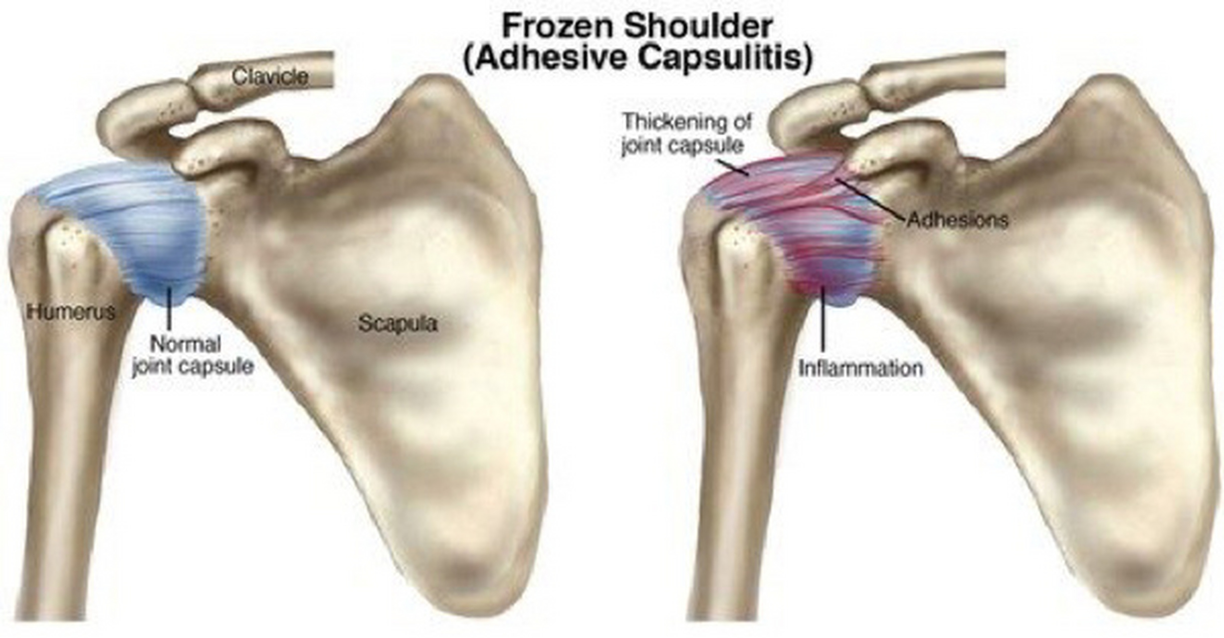 肩周炎 (adhesive capsulitis) (一) 肩周炎医学上称之为"粘连性肩