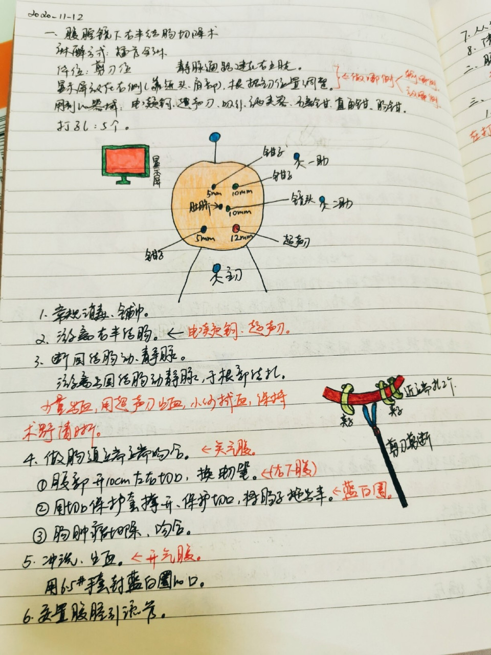 手术笔记:腹腔镜(右半结肠,胃)