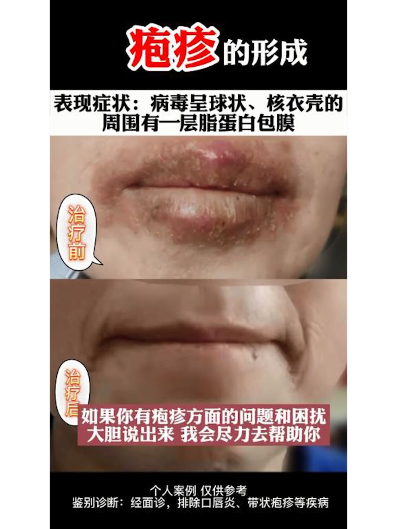 02 这位患者是口唇单纯疱疹,是由单纯疱疹病毒一型(hsv-1)引起的.