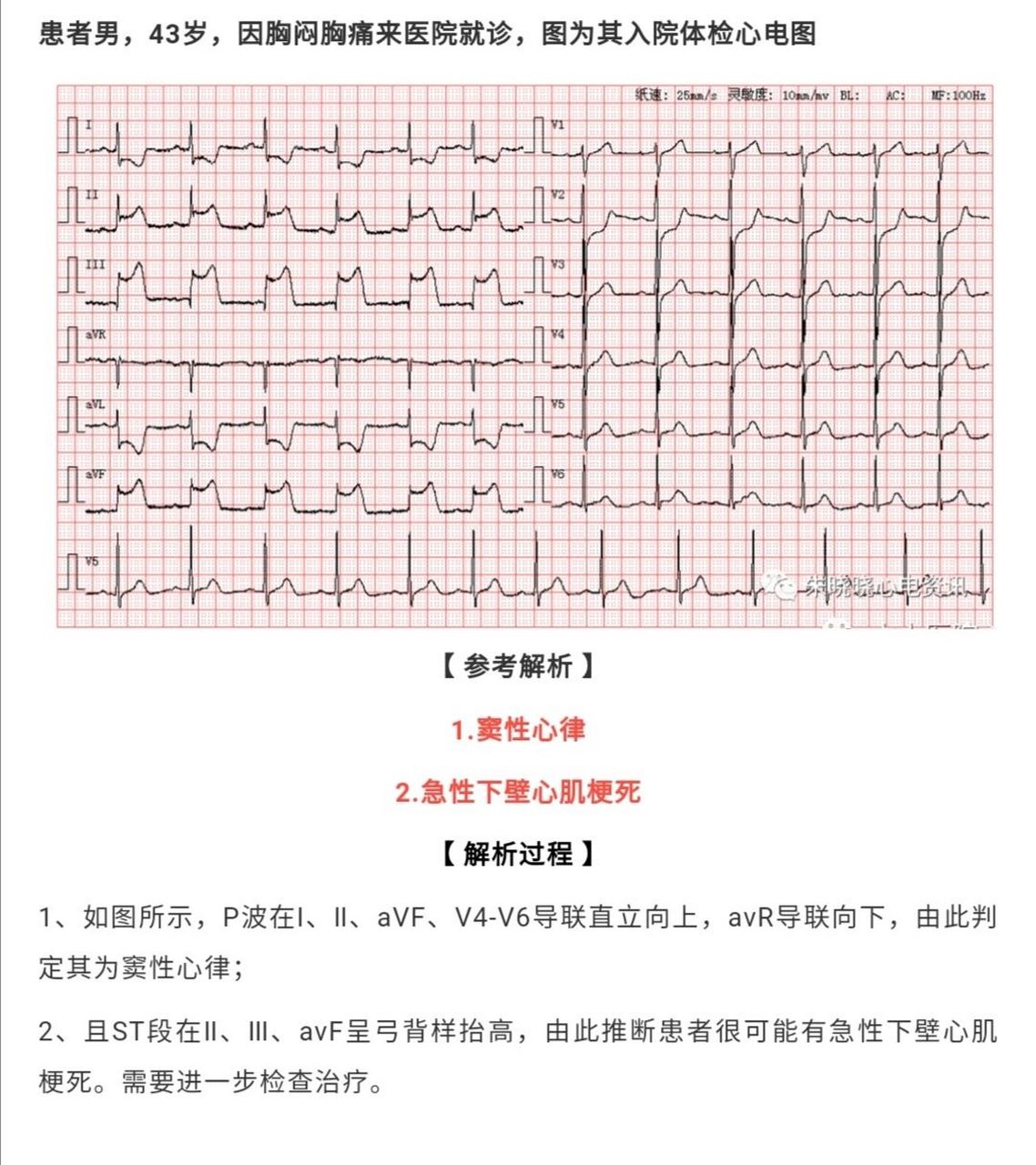 心梗心电图导联图片