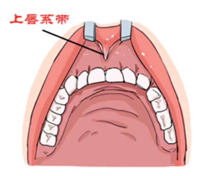 系带断裂图图片