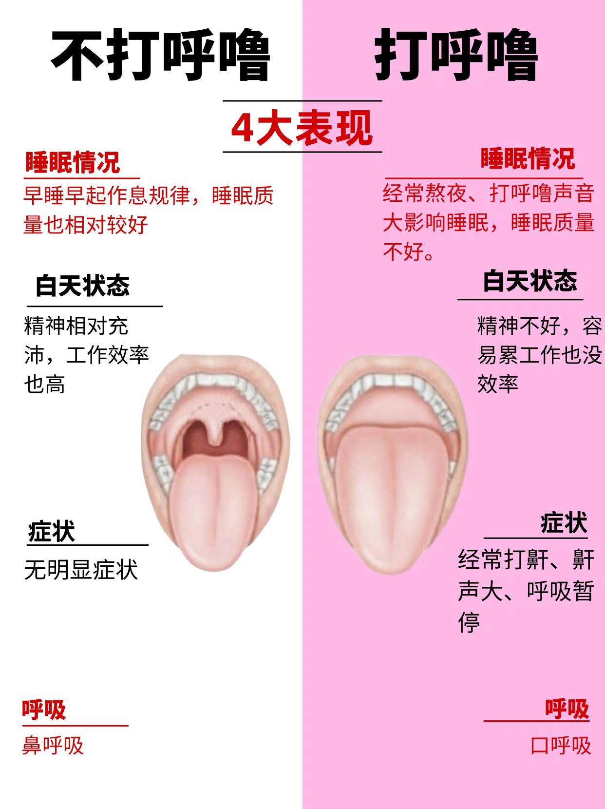 睡觉打呼噜甚至会窒息 那么打呼噜的话要怎么止鼾呢?