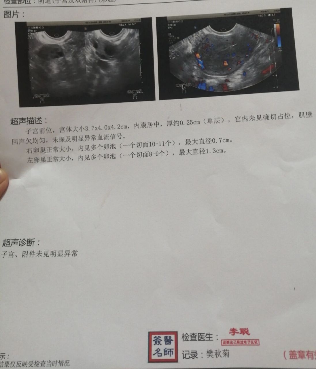 子宫动静脉瘘,好了 接上一篇发的话题,好多姐妹都问我子宫动静脉瘘是