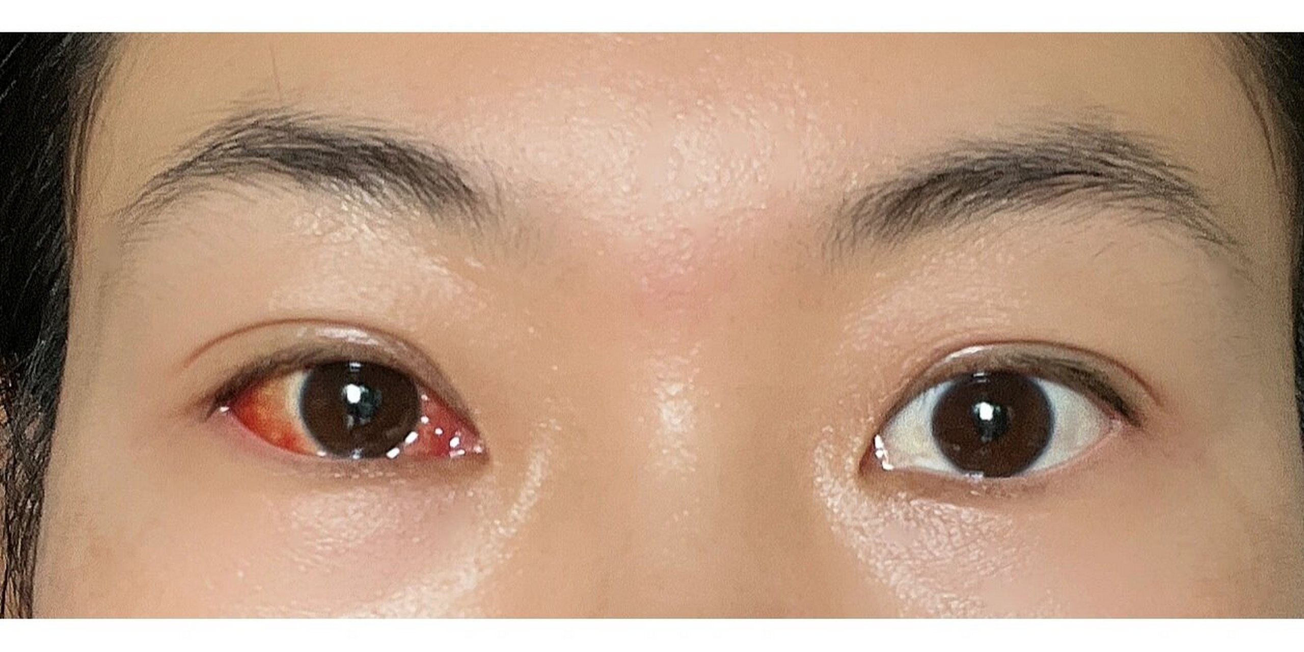 记录斜视手术第六天    今天是手术后第六天,眼睛充血也比较明显.