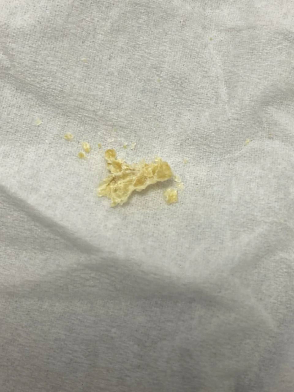 没几天就掏能出这么大坨耳屎正常吗?