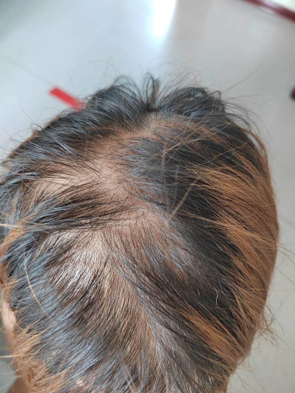 考虑雄激素性脱发症状.与遗传因素和后天因素关系密切.