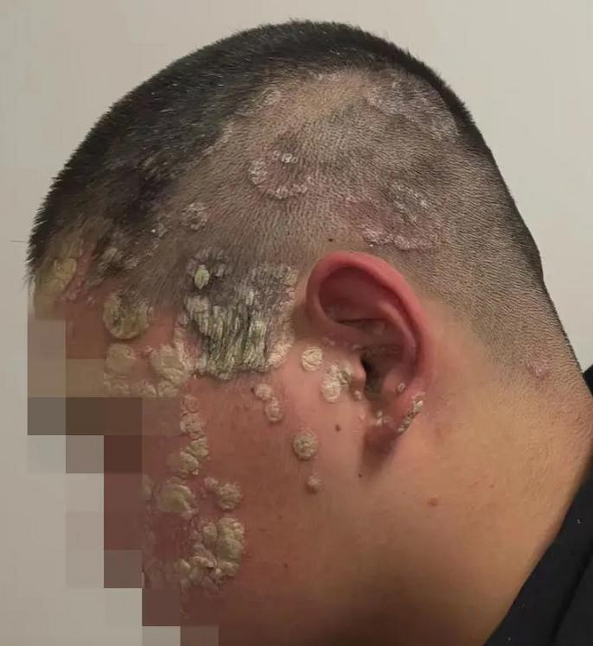 小伙银屑病蔓延到脸上,年纪轻轻也不容易  门诊一小伙子得银屑病三年