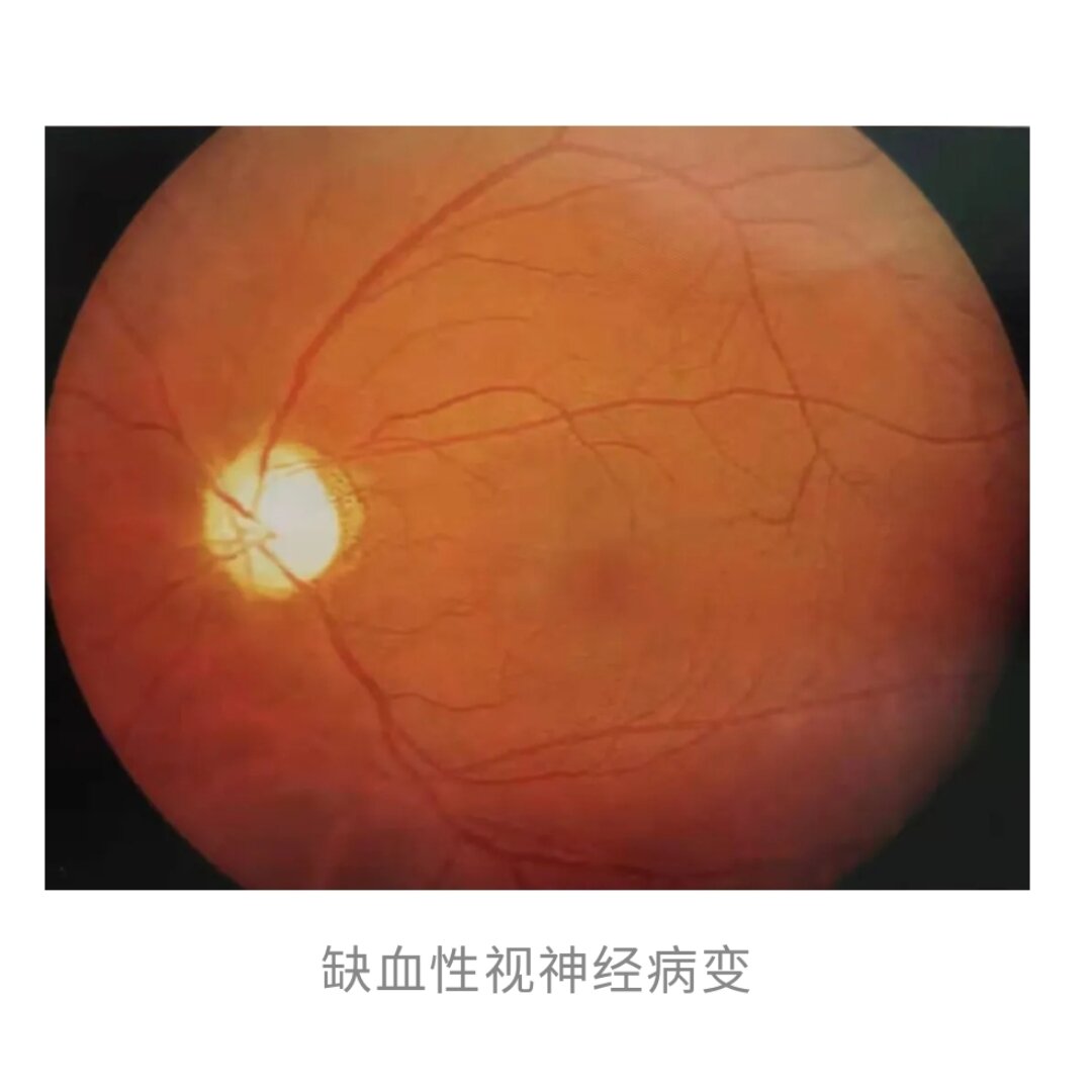 杯盘比增大了,青光眼了!