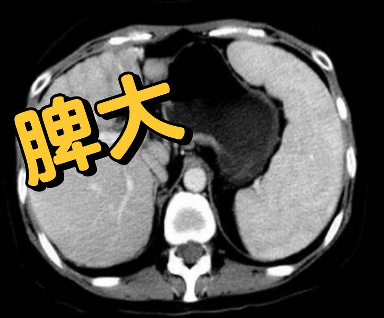 ct影像读片|脾大 1,脾脏在任一径线上>12cm;2,横断面图像上以5个肋