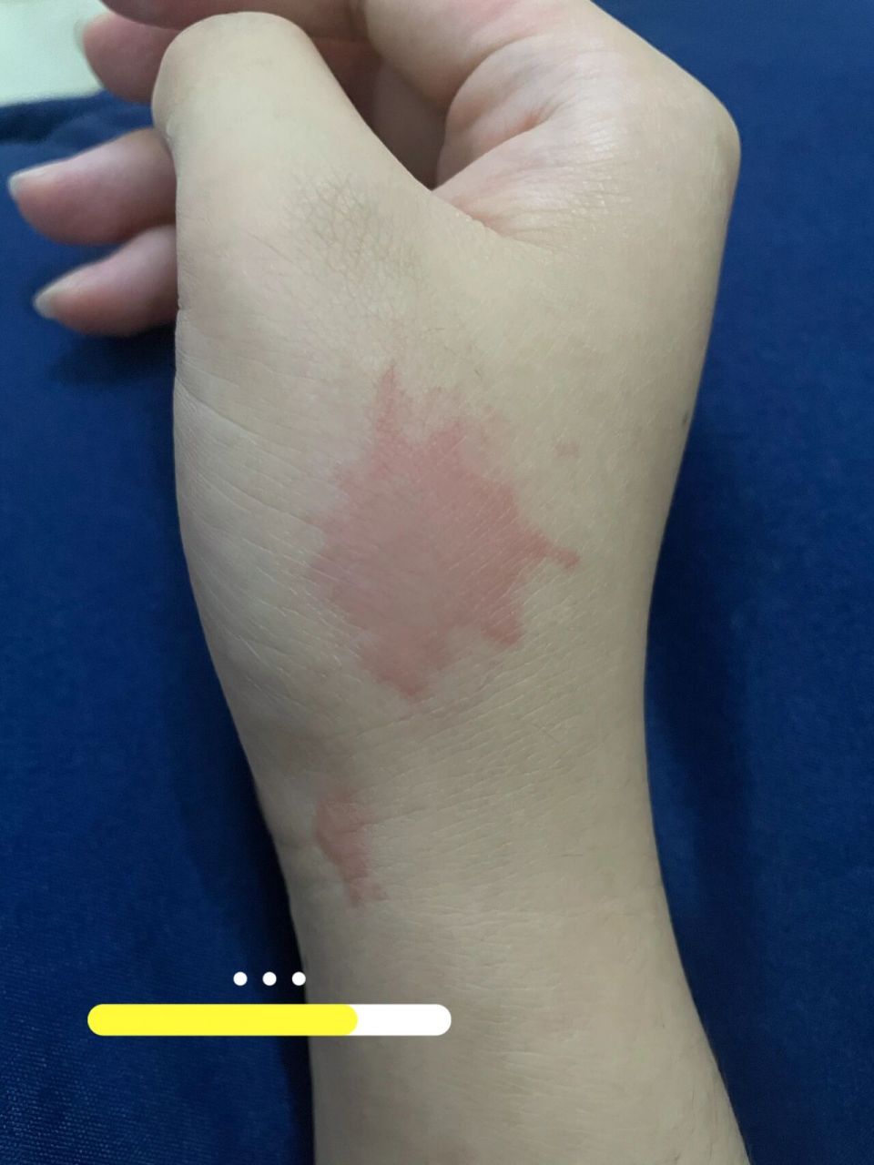 热油烫伤0303 人生第一回被热油烫到  以前不知道被烫到是长时间