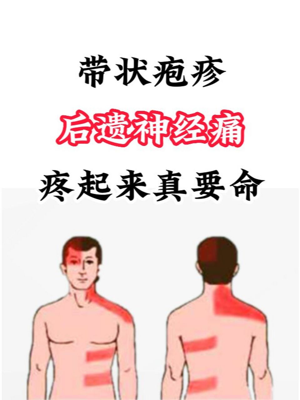 96带状疱疹系由水痘-带状疱疹病毒引起,此病毒一般潜伏在脊髓后根