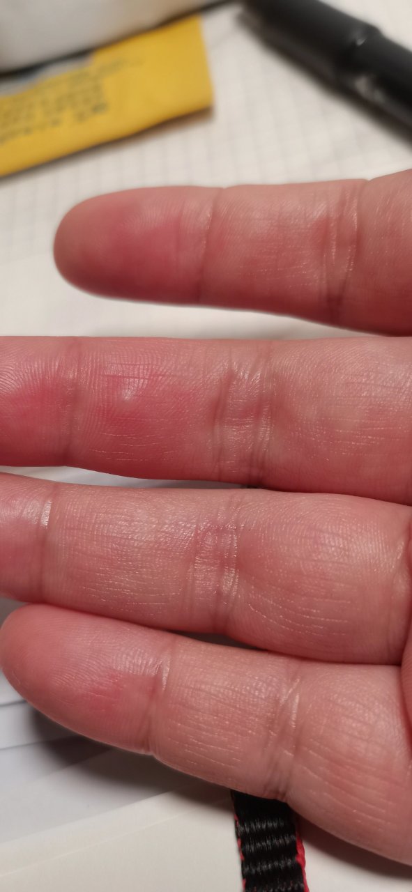 手指突然起个包 这包有点痒,有点疼,早上才起,一天没消.