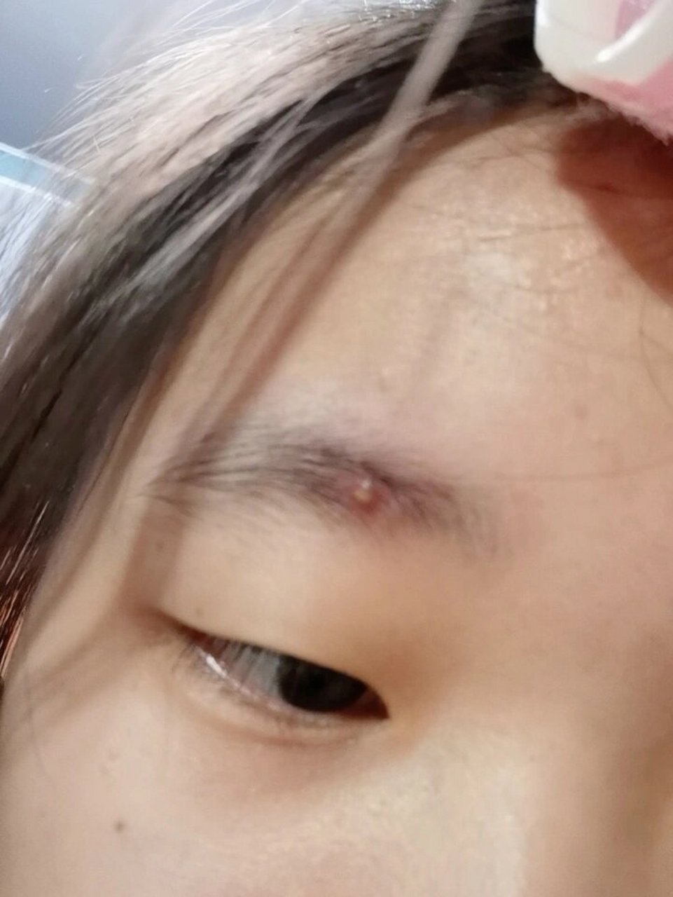 救命眉毛里长了这么大一个痘痘是为啥,而且还疼
