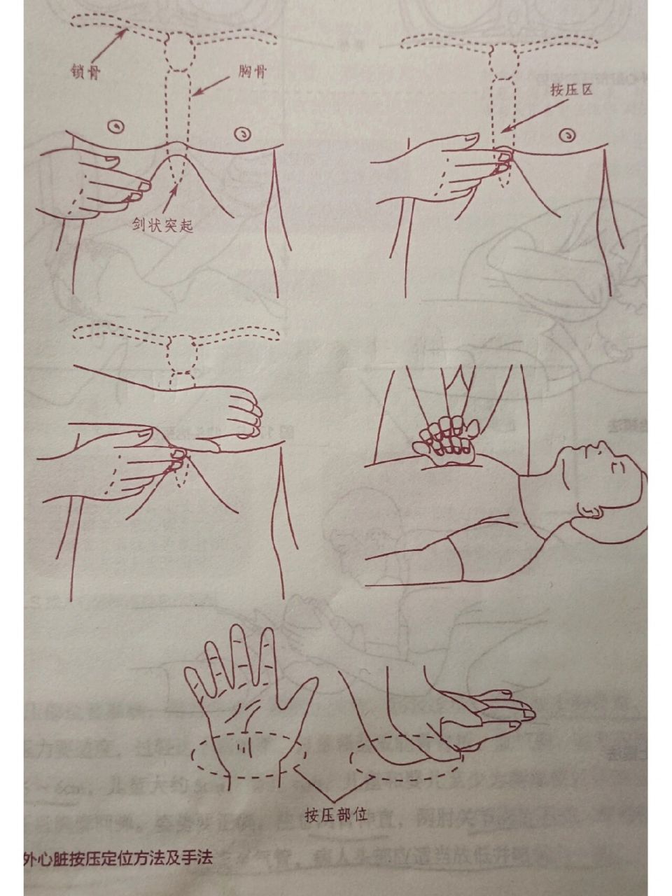 心肺复苏手法图和按压有效判断   【操作步骤】 步骤 1.