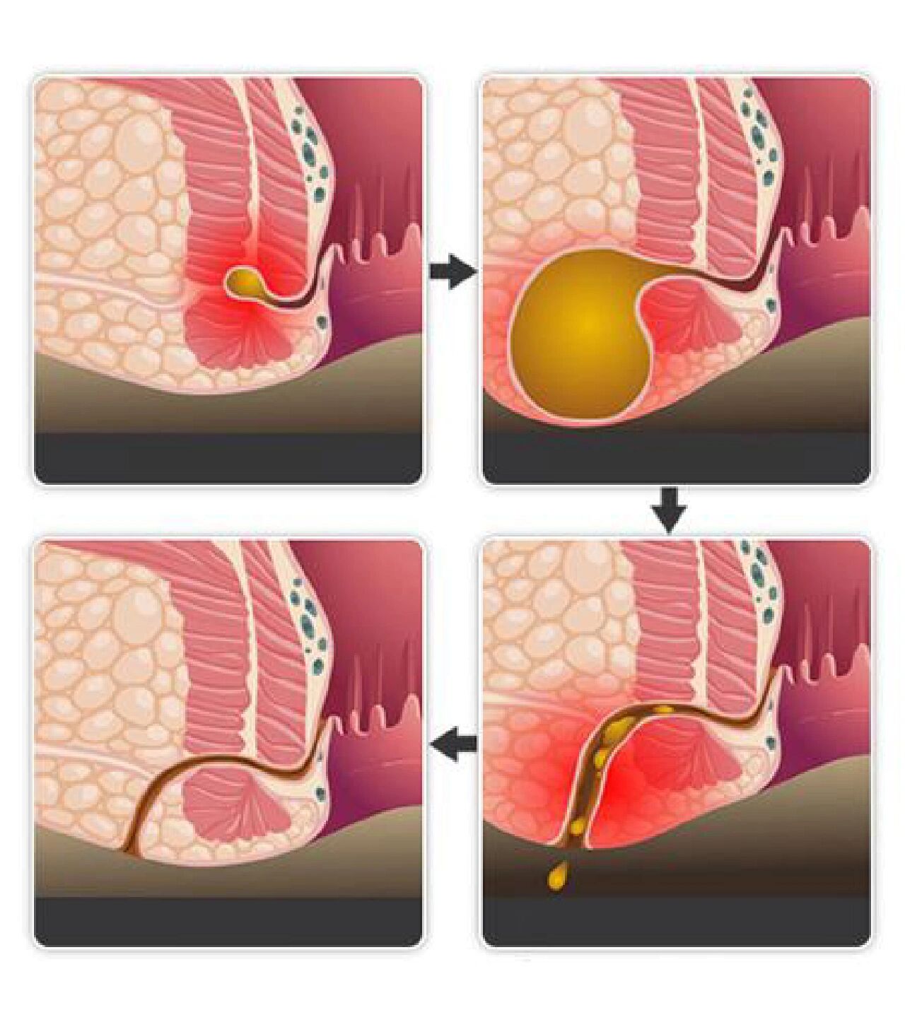 肛门脓肿怎么治最好图片