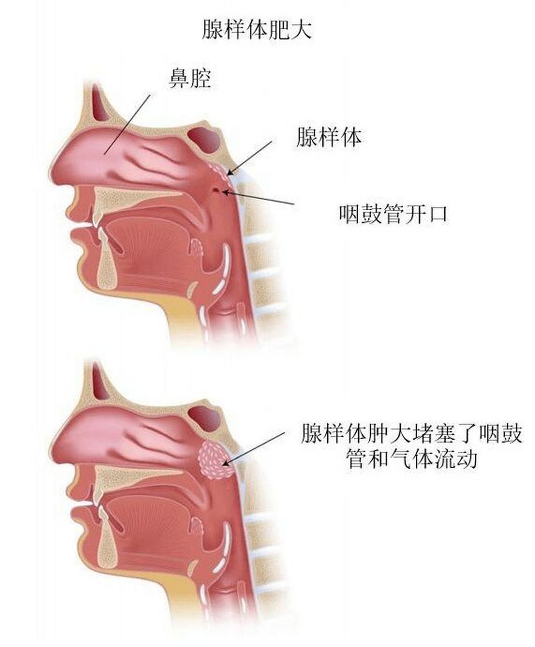 腺样体肥大有哪些表现?