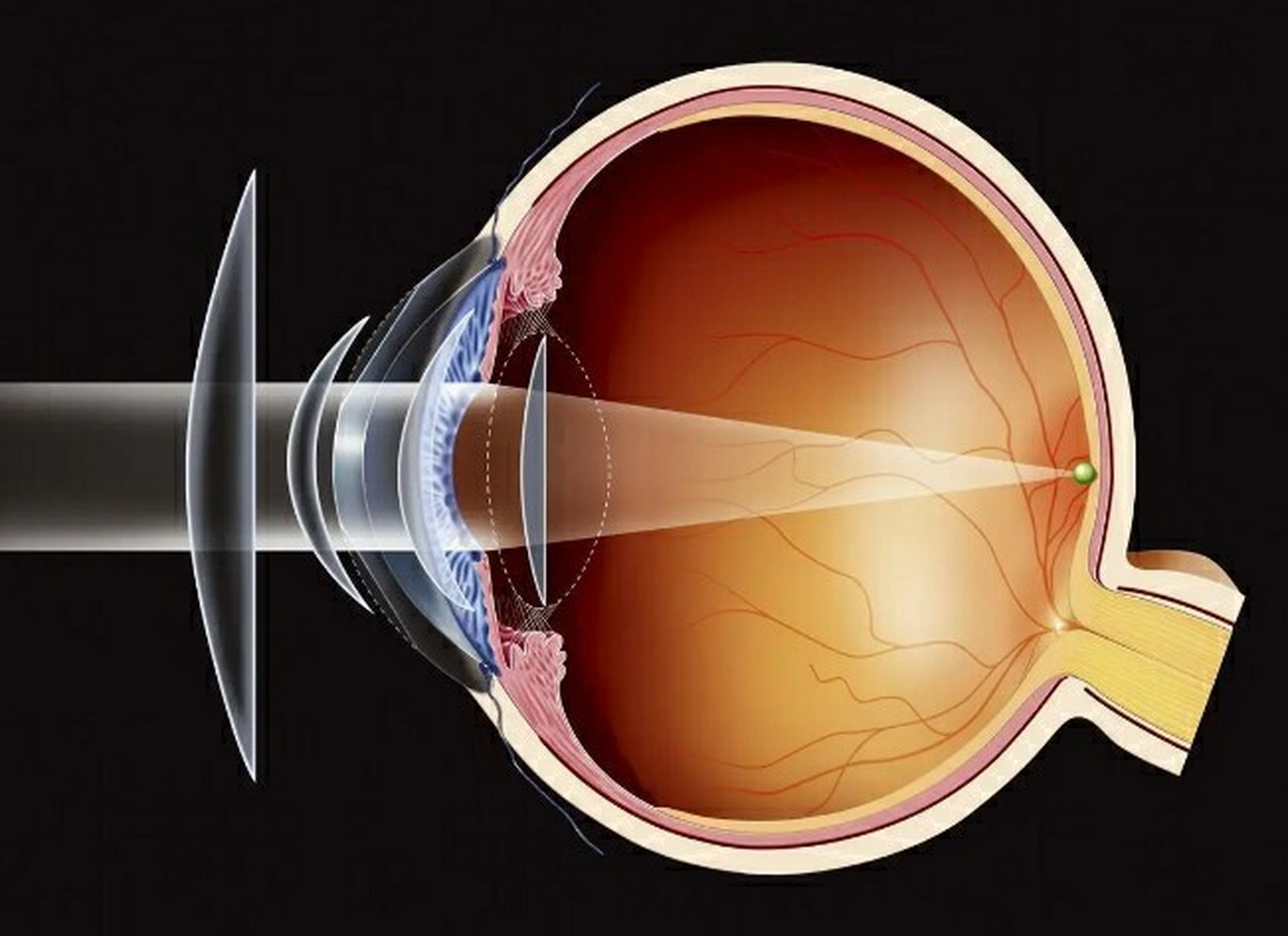 这几个方法能赶走它 眼球震颤,英文名称为nystagmus,简称为眼震,一种