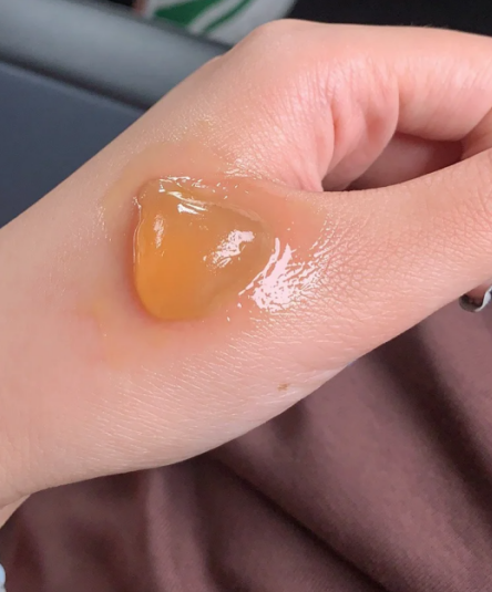 烫伤后起的水泡能不能挑破,要看水泡的具体情况