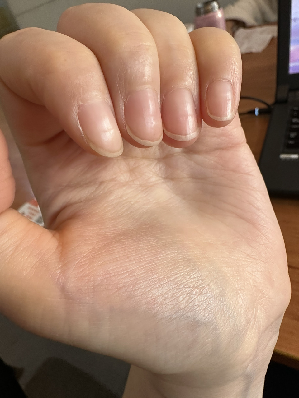 指甲凹陷是什么原因 十个指甲,每个指甲中部凹进去一点点,个别指甲也