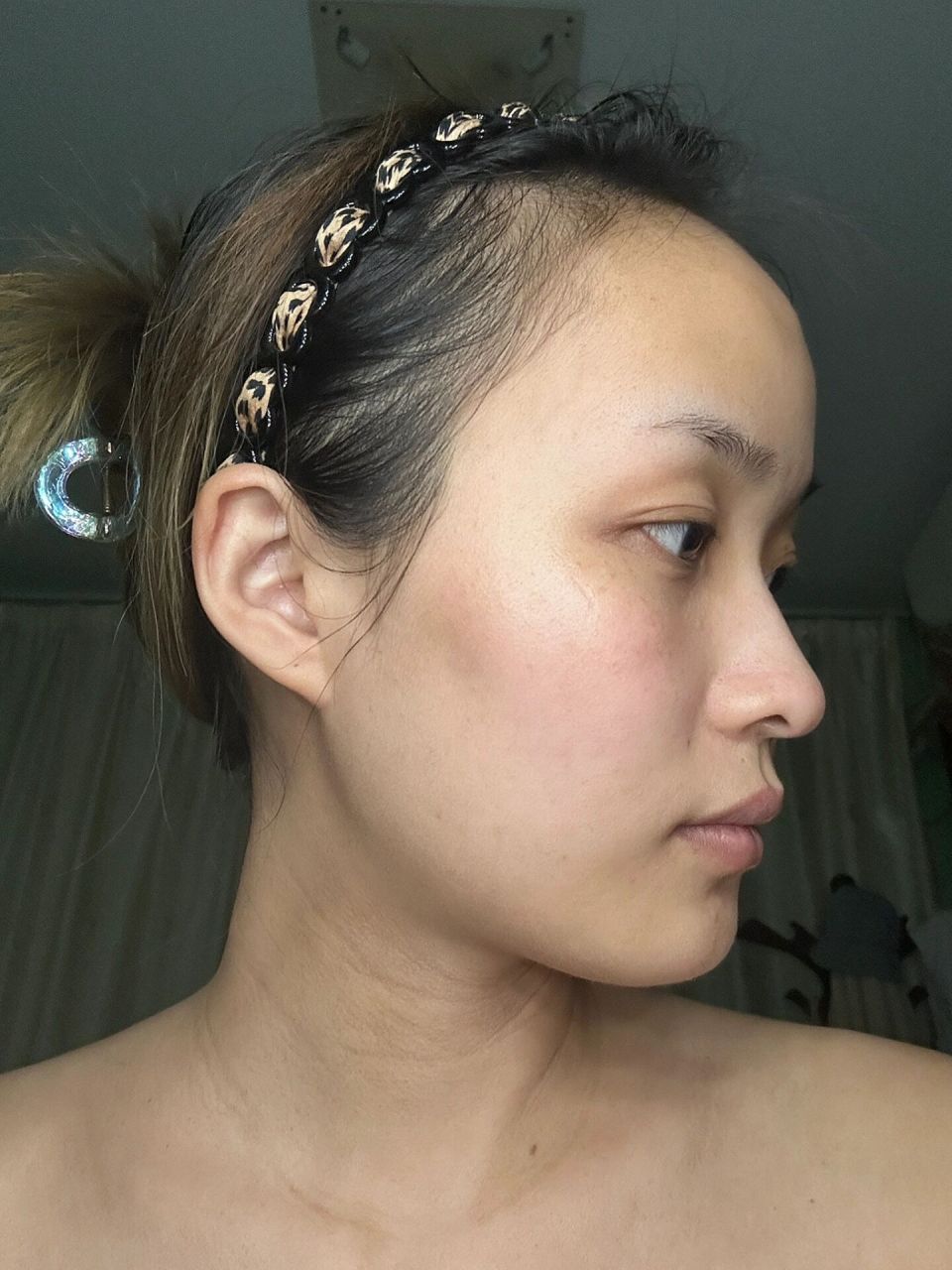 我愿称之为最丑脸型没人反驳吧08 太阳穴凹陷/颧骨突出/面颊凹陷 还