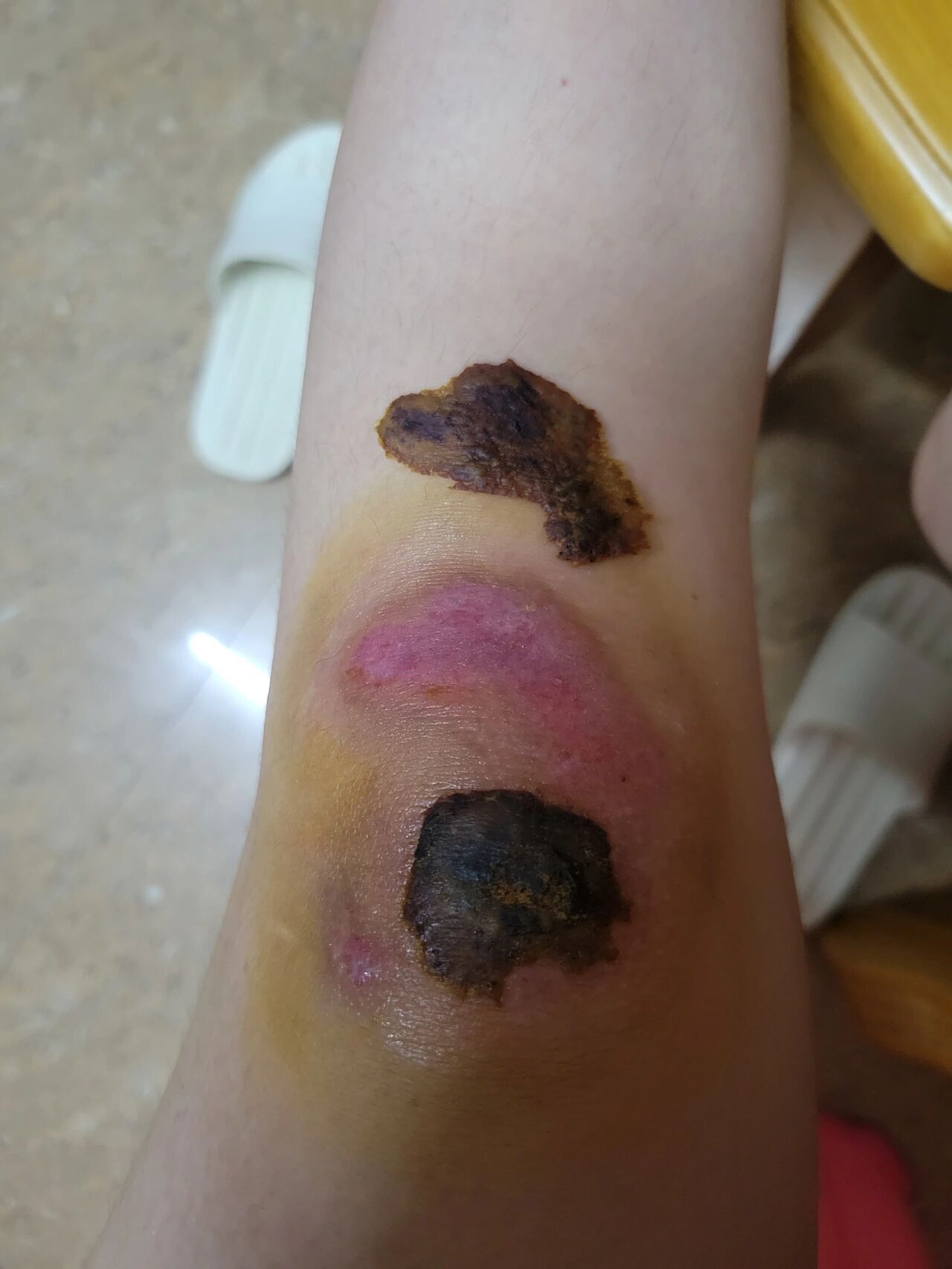 膝盖摔伤第22天 终于掉了一块痂哈哈哈哈哈,喜辽妥安排上