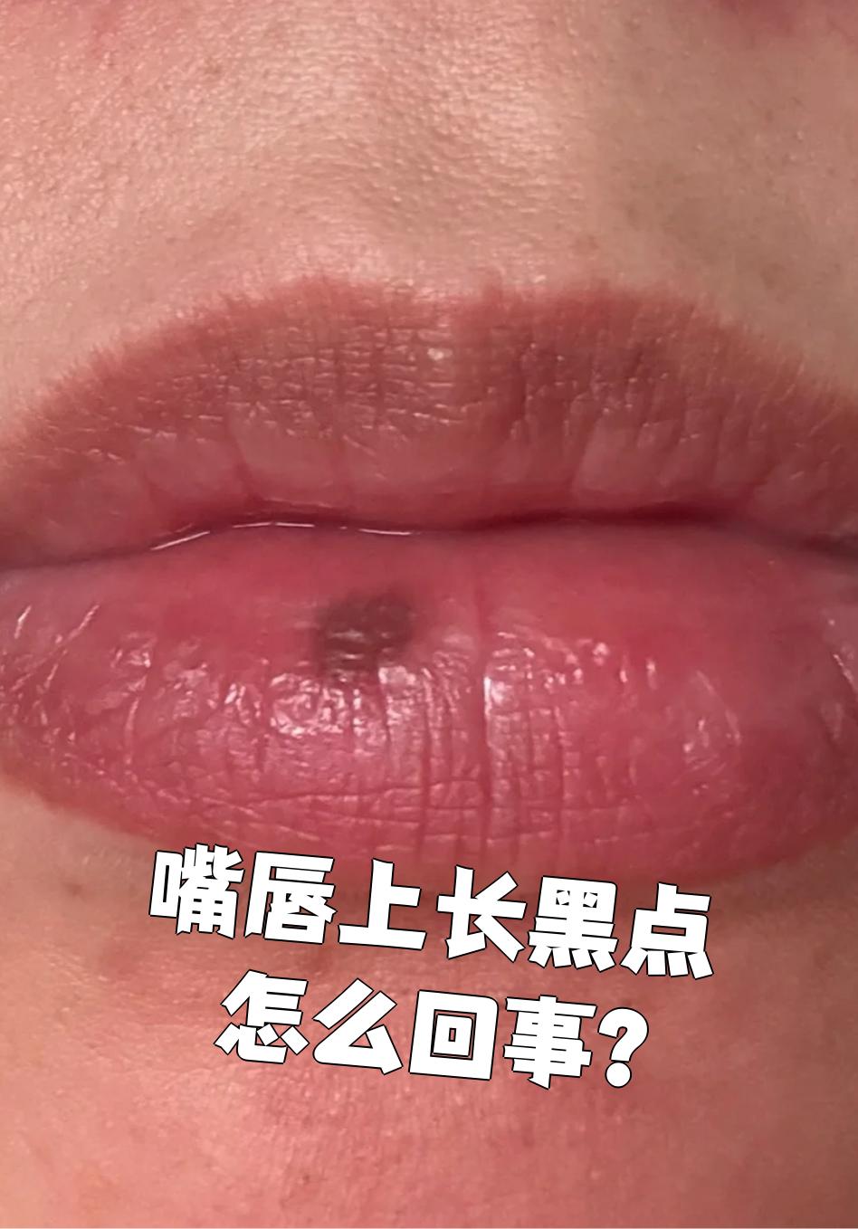 嘴唇上长黑点最常见的原因是黑色素沉着,但也可能是色素沉着息肉