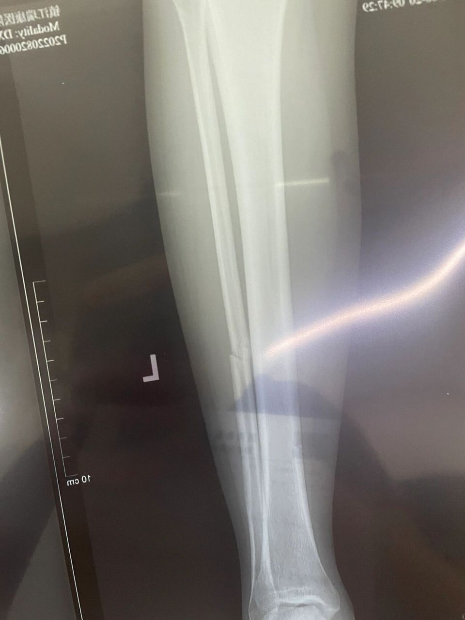 腓骨骨折 骨折两个月复查感觉还没长好,怎么这么慢?