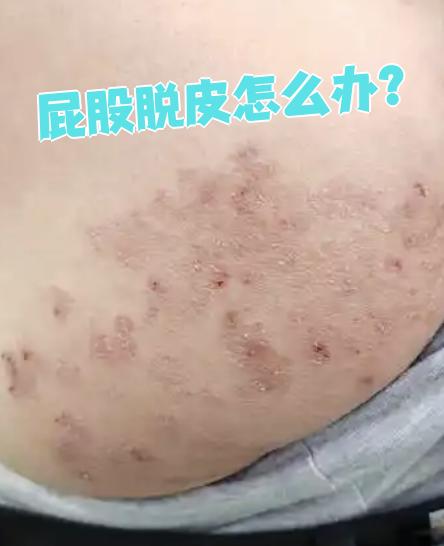 屁股脱皮怎么办?
