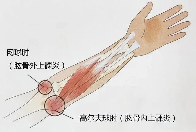 有种疼痛叫妈妈肘肱骨外上髁炎又叫网球肘,妈妈肘