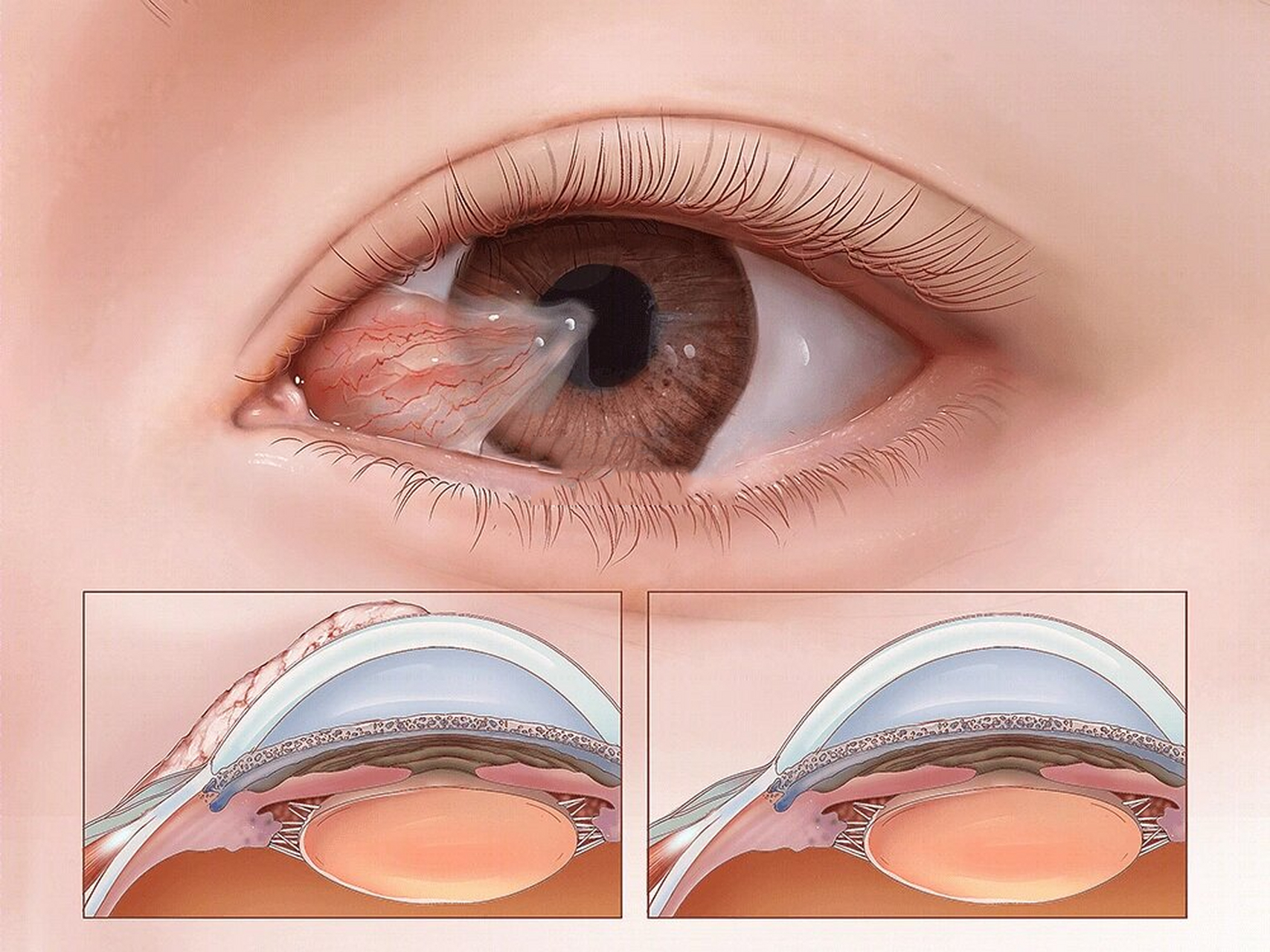 什么是翼状胬肉?