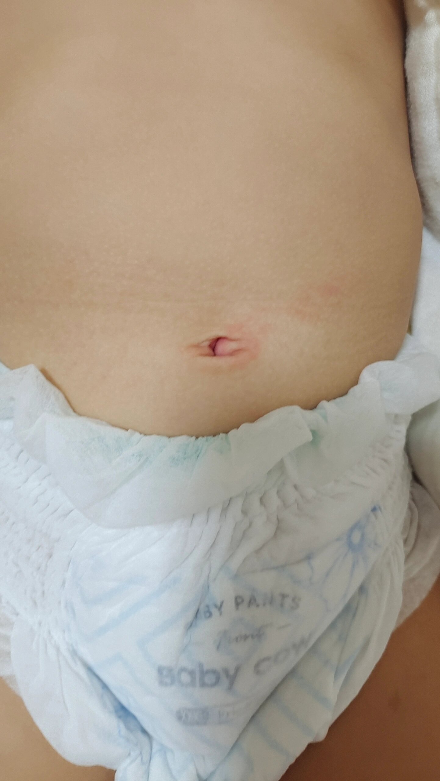 不懂就问,肚脐红有遇到过的麻麻们不