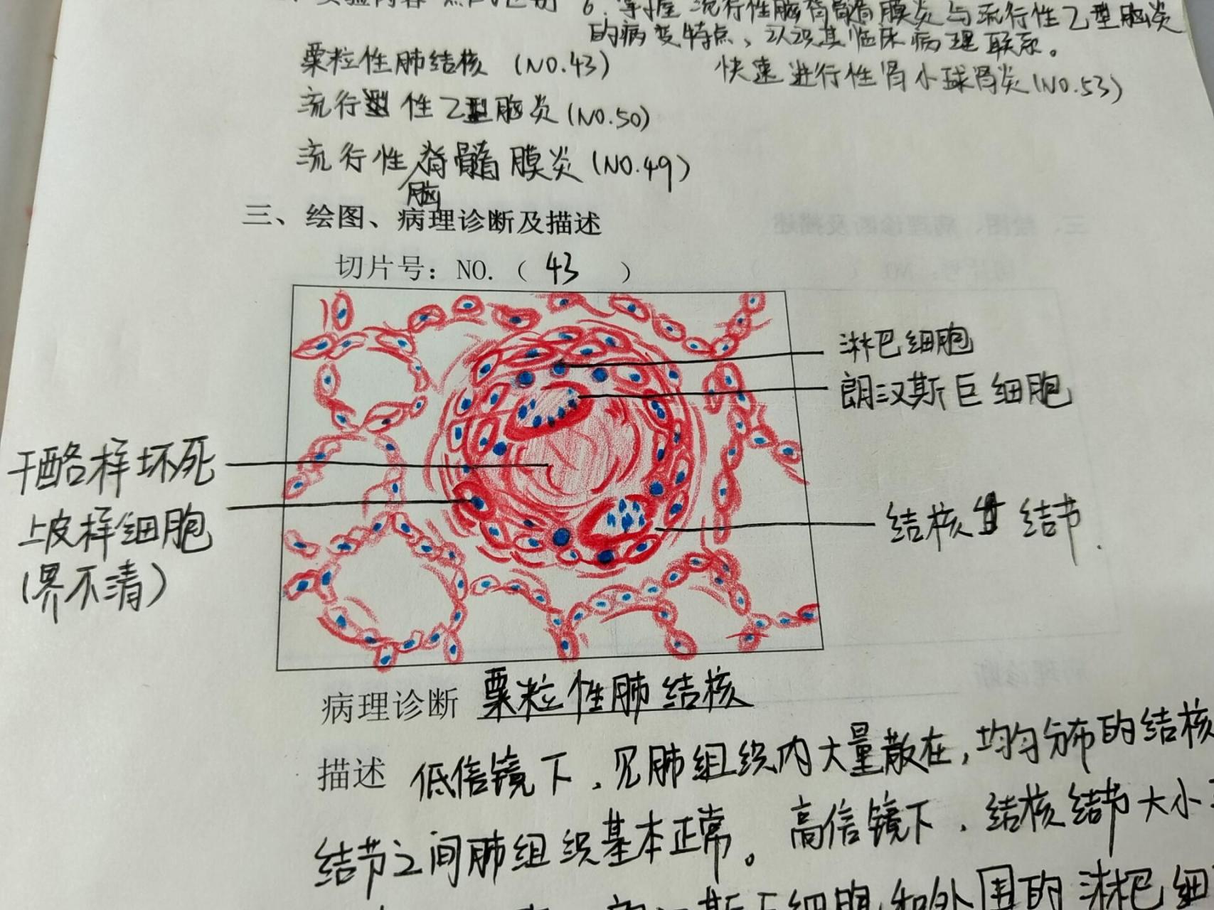 肺结核手绘图图片