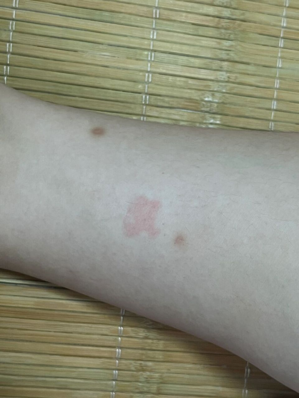 求助:这个是灸花还是烫伤了 灸的三阴交 左右腿一起的 右腿有  按压会