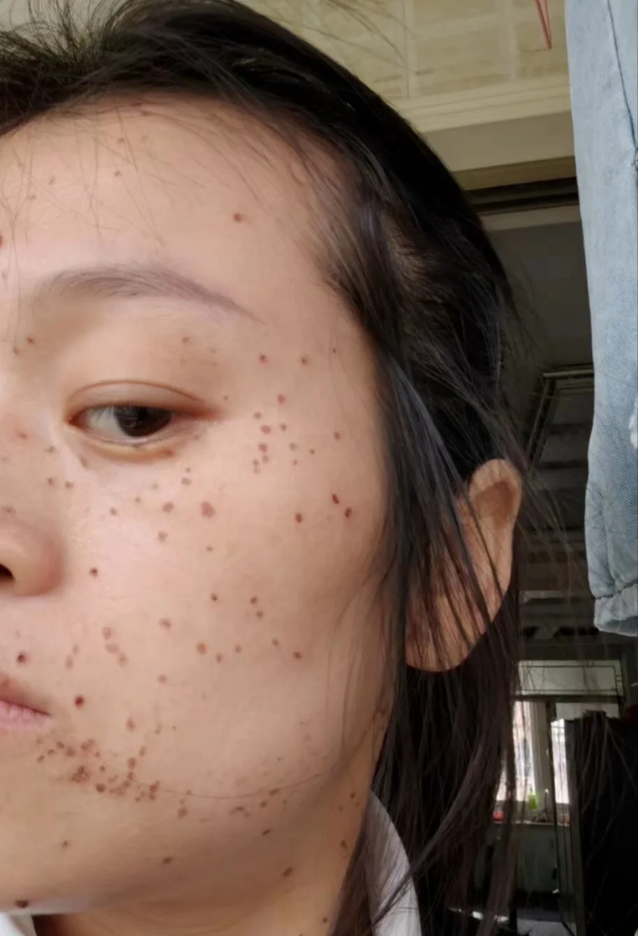 雀斑,遗传性雀斑 只有雀斑和遗传性雀斑才可以根治,而且不是一步到位
