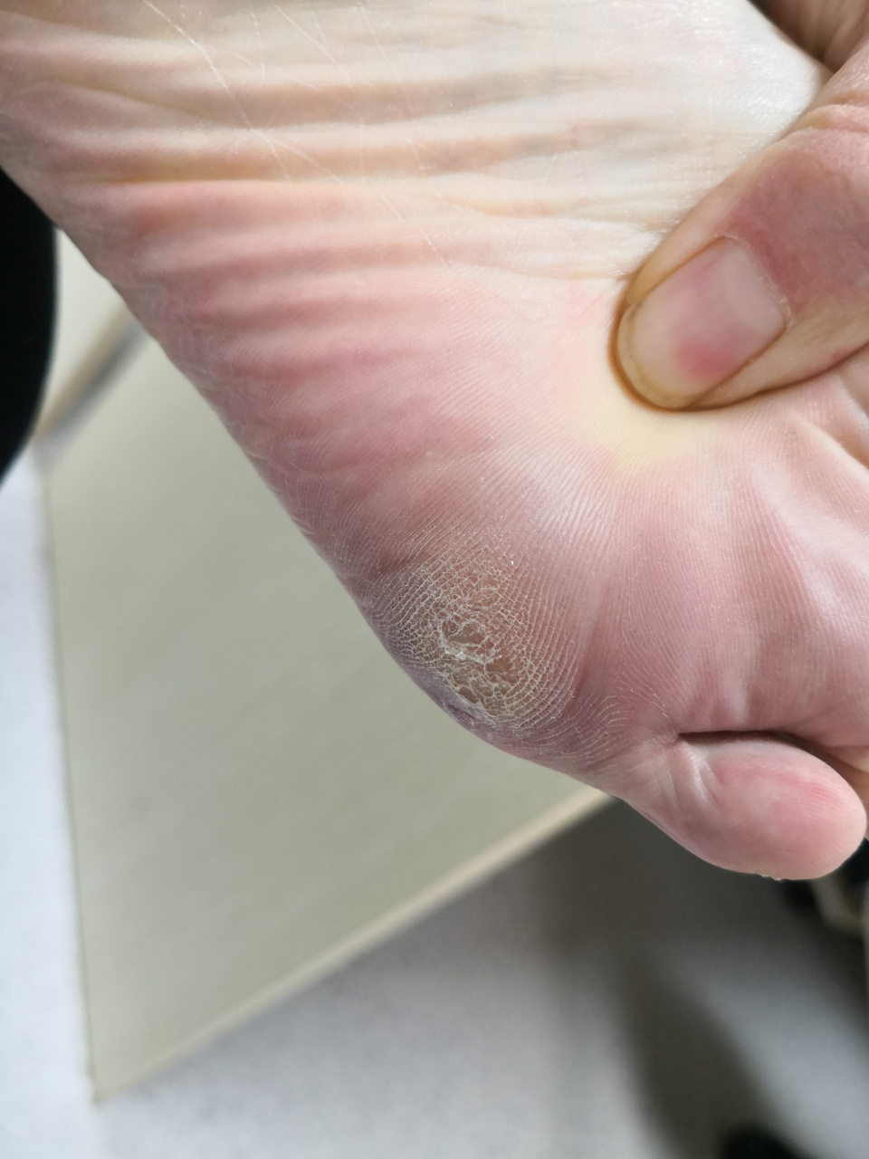 考虑胼胝,鸡眼排除一下跖疣可能.#胼胝