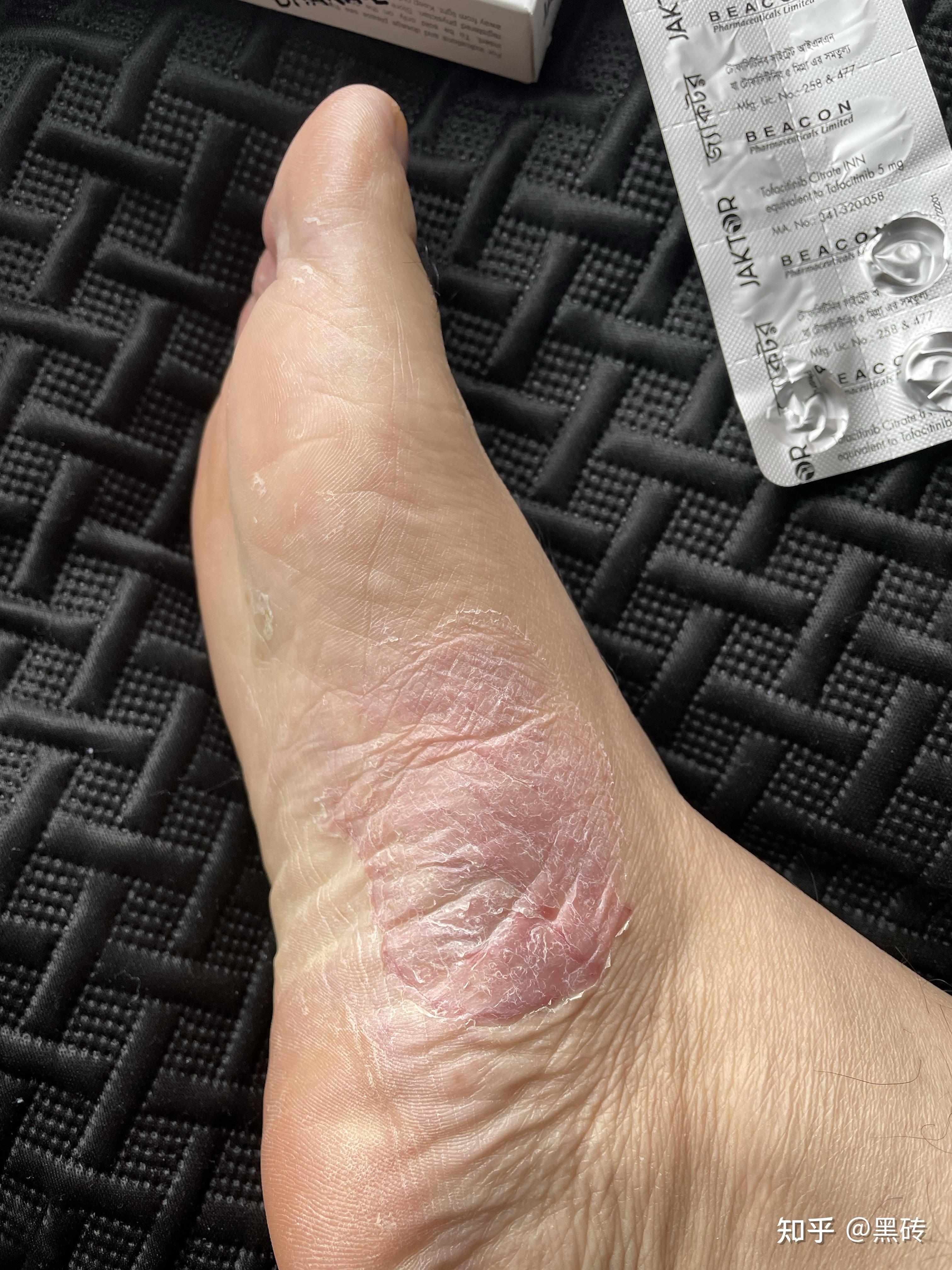 有着十几年的银屑病牛皮癣是否应该要嫁人