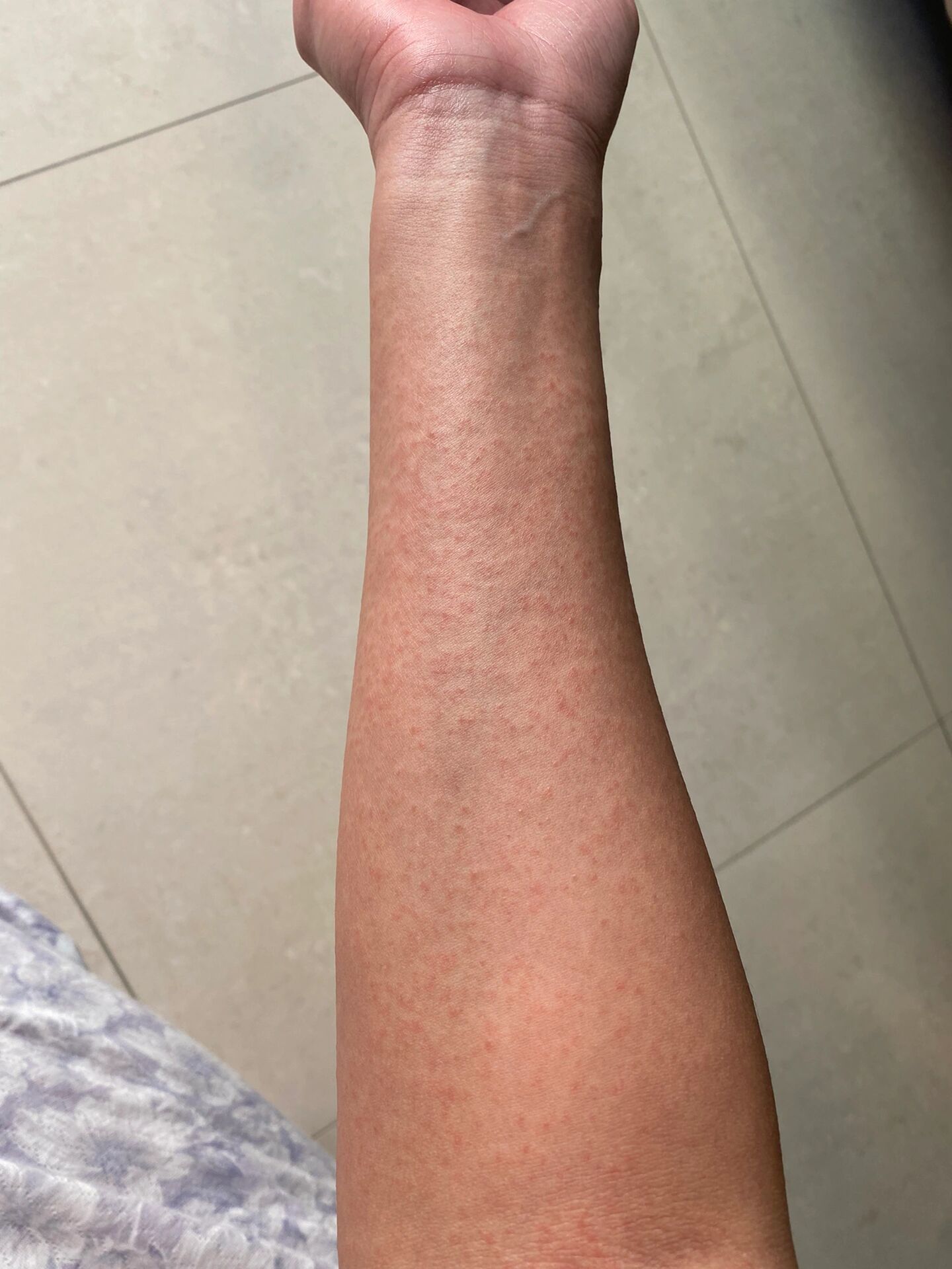 酒精过敏 上半身全部长红疹,搽药没用,阳了之后为了宝宝一直用酒精