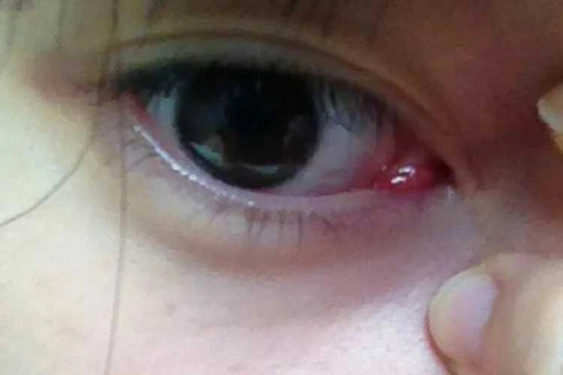 内眼角又红又痒又痛 图片来自网络 我自己拍拍不出实际那么红 但是我