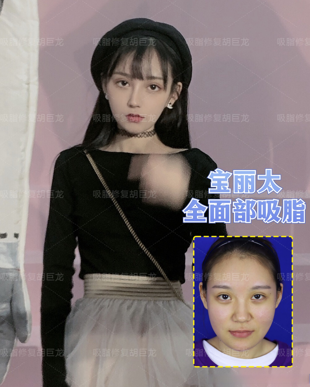 分享一个面部吸脂 鼻综合术后远期的恢复图  面部脂