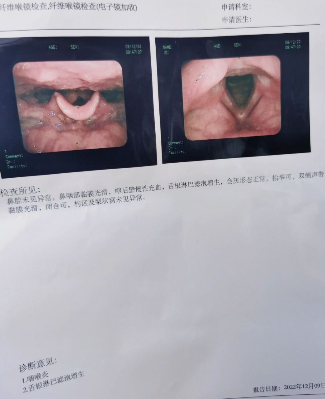 喉镜初体验,咽喉炎雾化七天 甲状腺术后入冬嗓子一直有异物感,严重