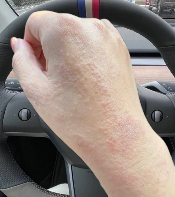 手背干裂,发红,刺痛,很痒常见原因包括皮肤干燥,寒冷天气,湿疹,渐触