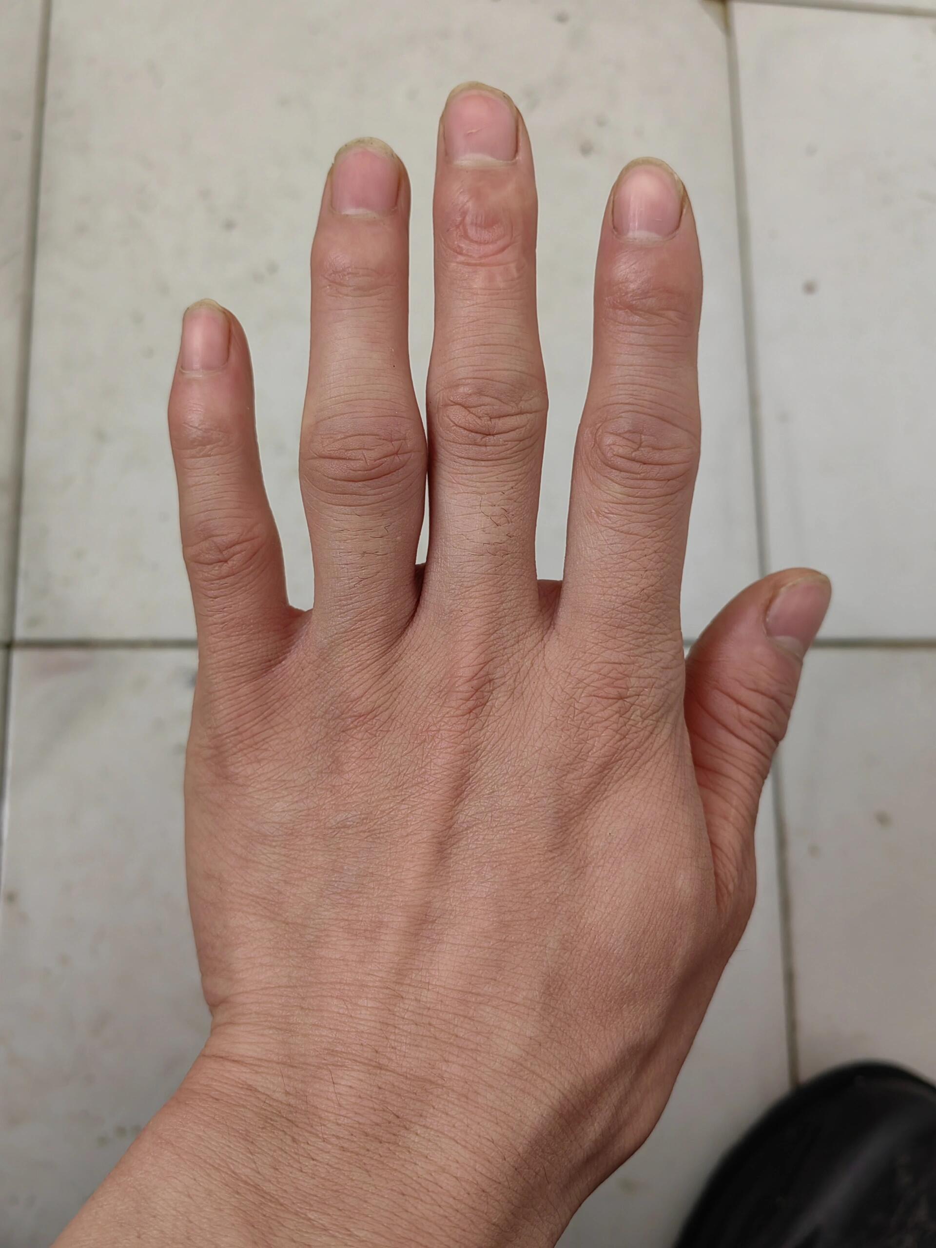 今天是类风湿关节炎的,手指肿痛的32天.