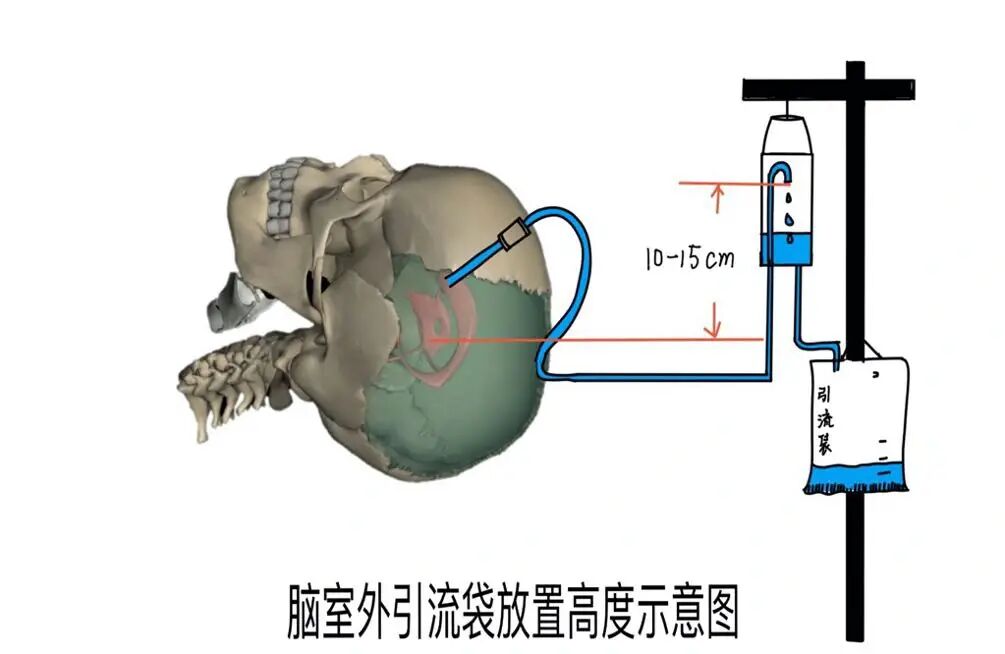 脑脊液引流术图片图片