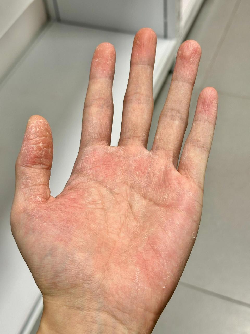 手蜕皮好久了,最近变得面积大,覆盖范围广,但是翘皮轻了很多.