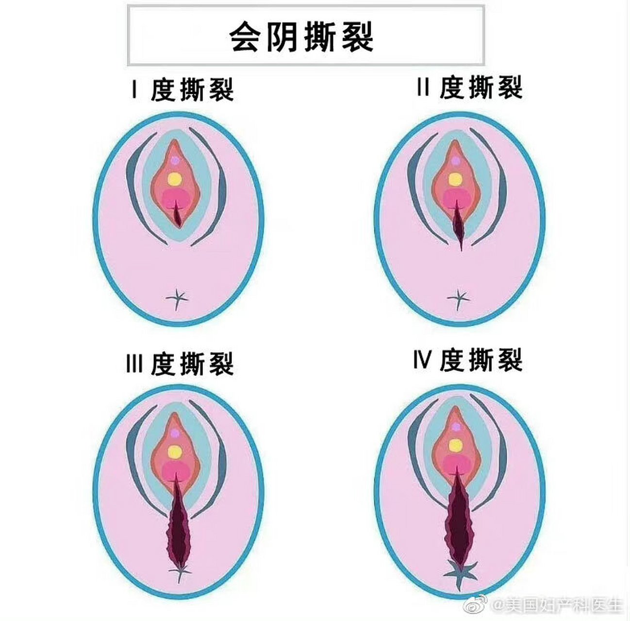 导致撕裂严重,(最后看出院报告上写的是2度撕裂)等医生来的时候一直在