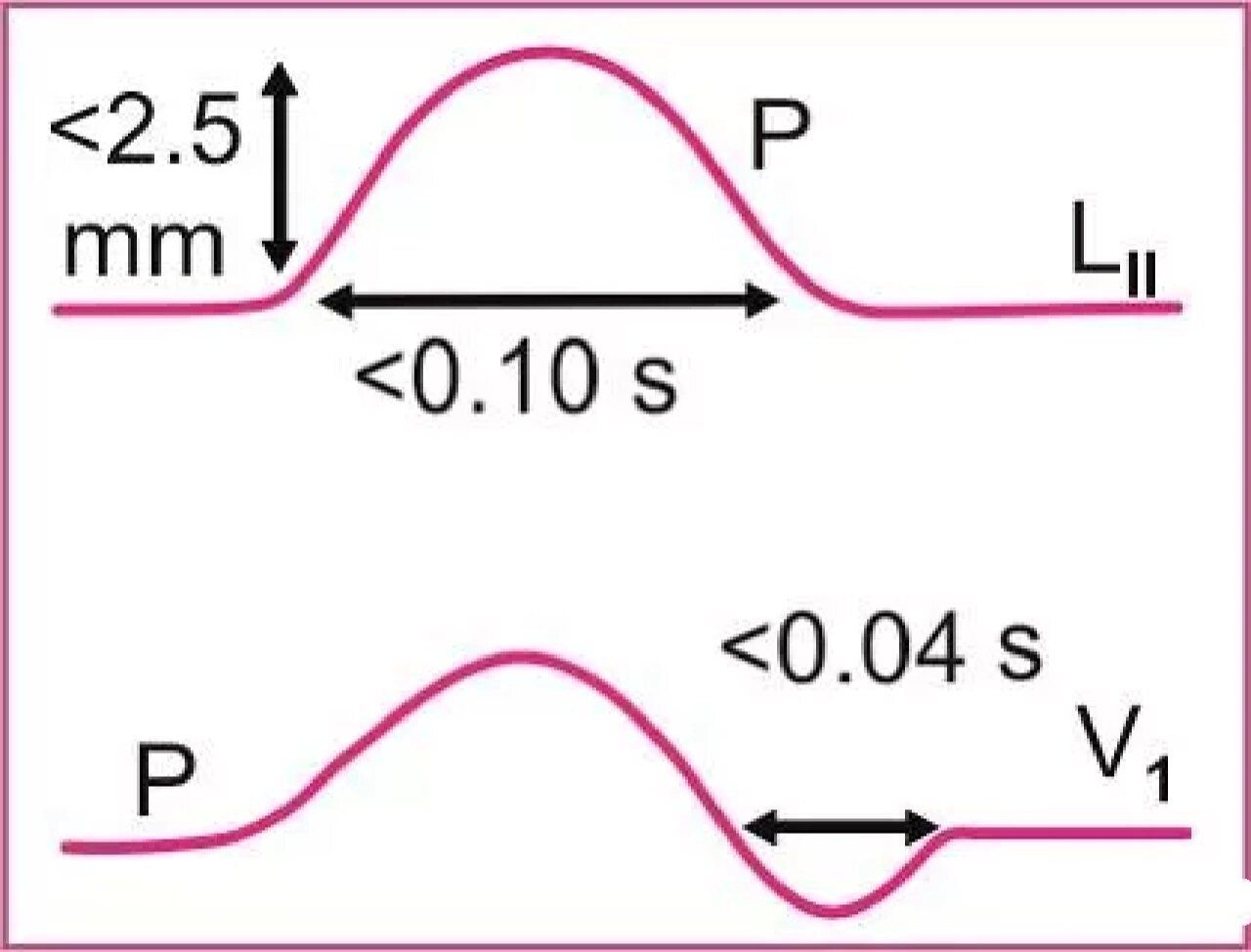 正常p波需符合以下标准: 图片 图1 正常p波 ❖大多数导联直立(avr,v