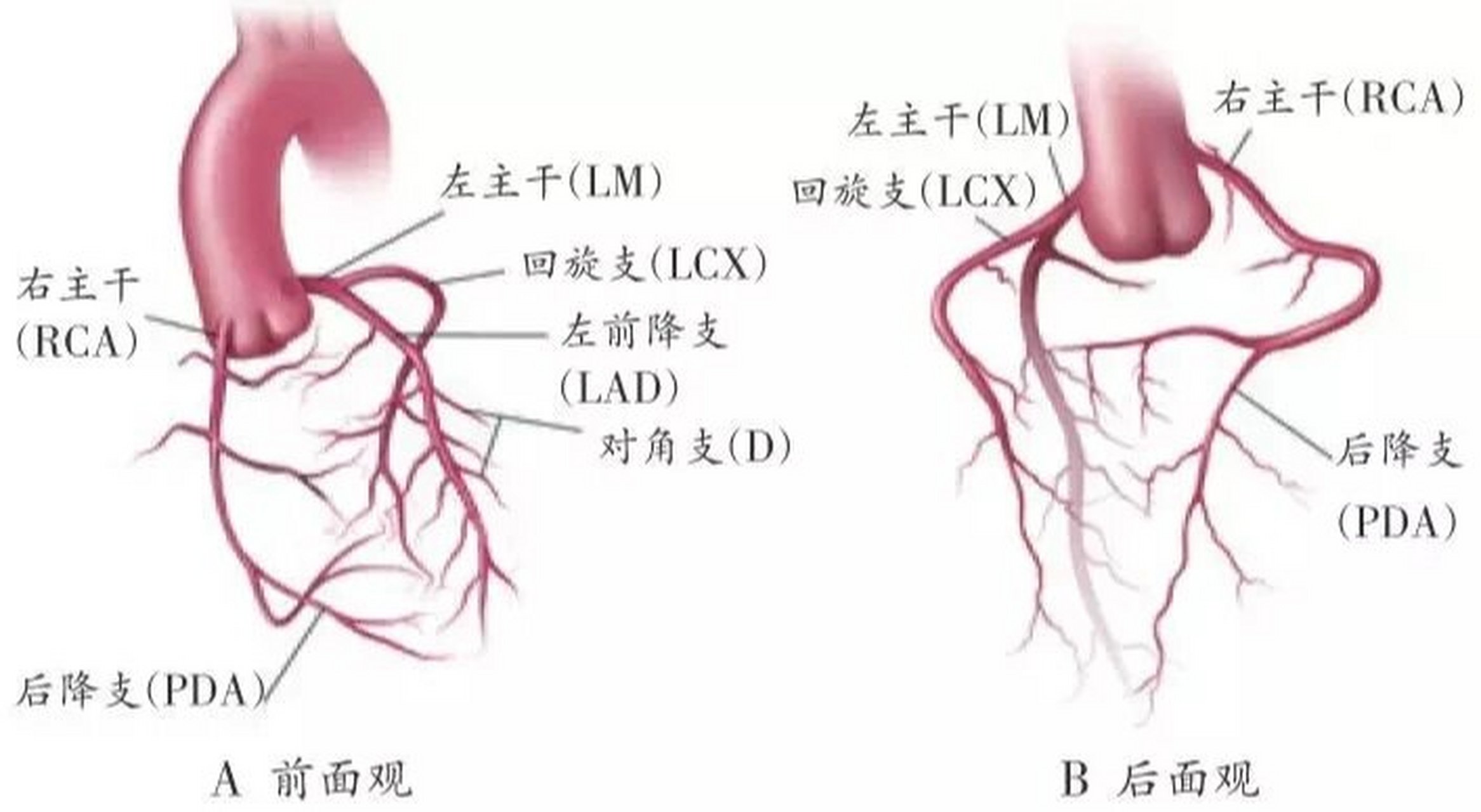 冠状动脉解剖图钙化图片